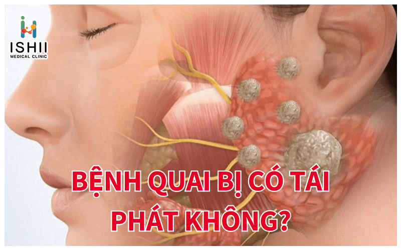 Bệnh quai bị có tái phát lại không?