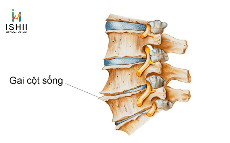 Bệnh gai cột sống