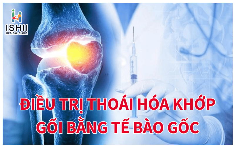 Điều trị thoái hóa khớp gối bằng phương pháp tế bào gốc