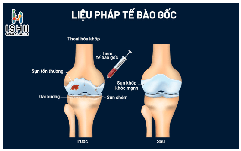 Điều trị thoái hóa khớp gối bằng tế bào gốc có thực sự hiệu quả?