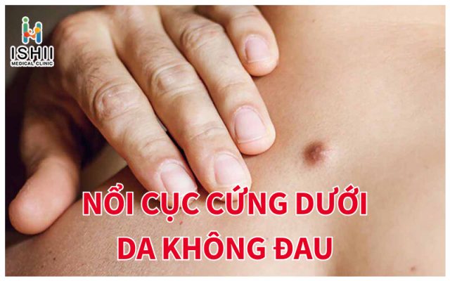 Tình trạng nổi mụn cục cứng dưới da không đau