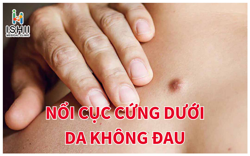 U nang biểu bì: Tình trạng nổi mụn cục cứng dưới da không đau